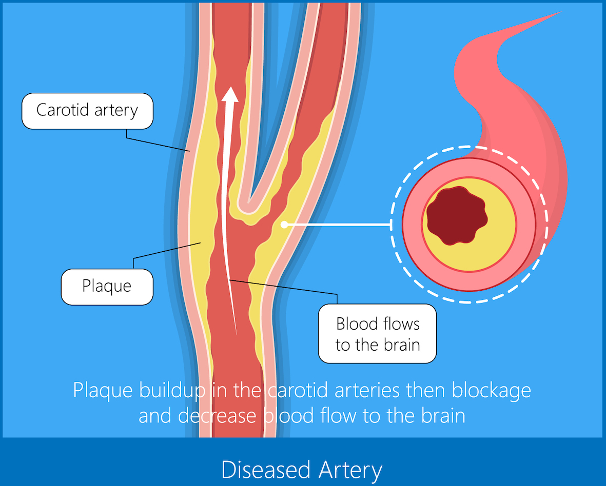 Carotid Artery Stenting Vista Vascular Clinic