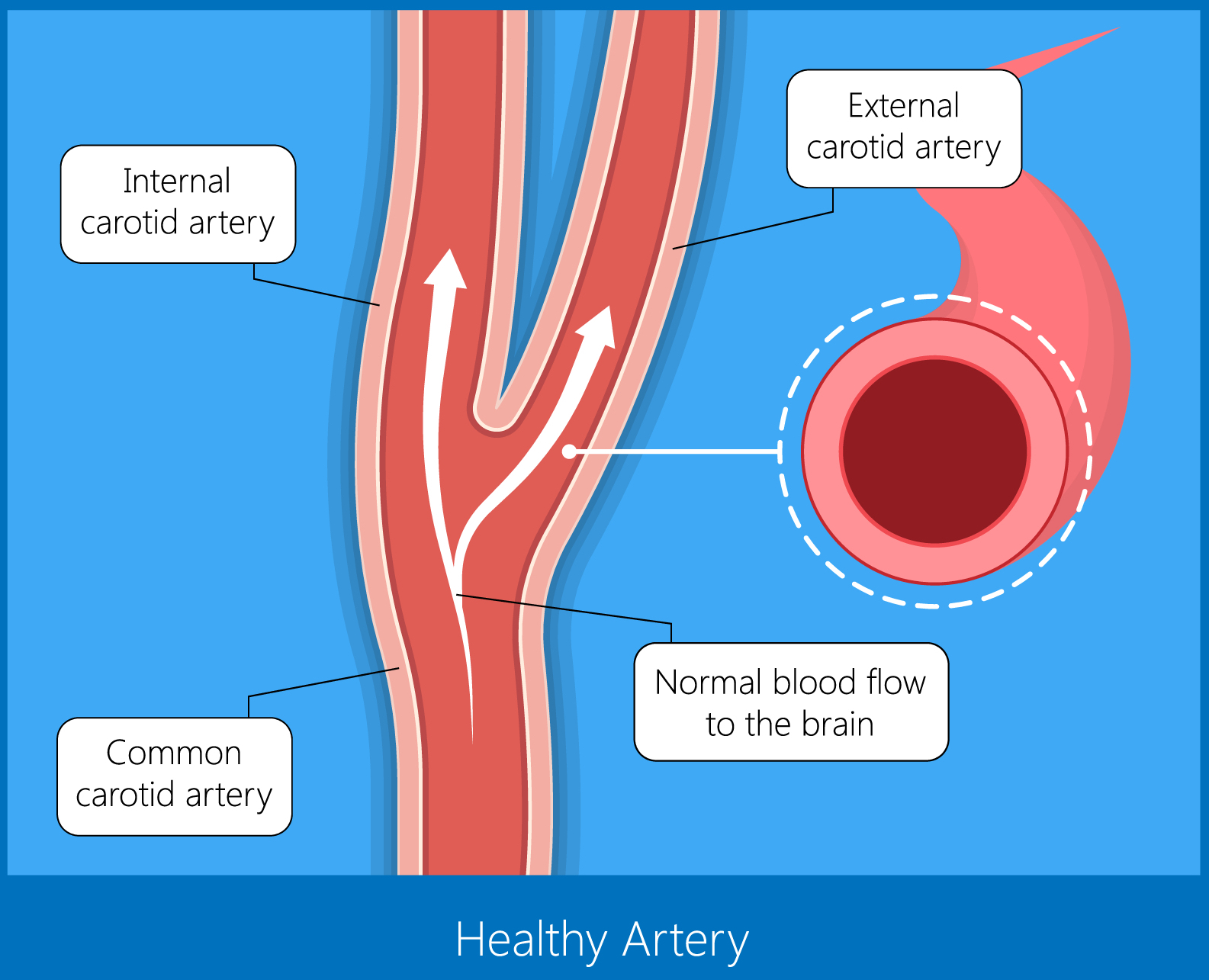 Carotid Artery Stenting Vista Vascular Clinic 8263