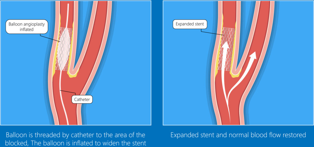 Carotid artery stenting - Vista Vascular Clinic