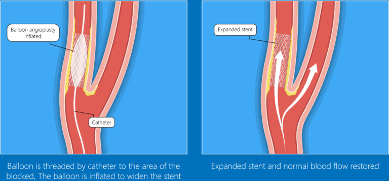 Carotid artery stenting - Vista Vascular Clinic