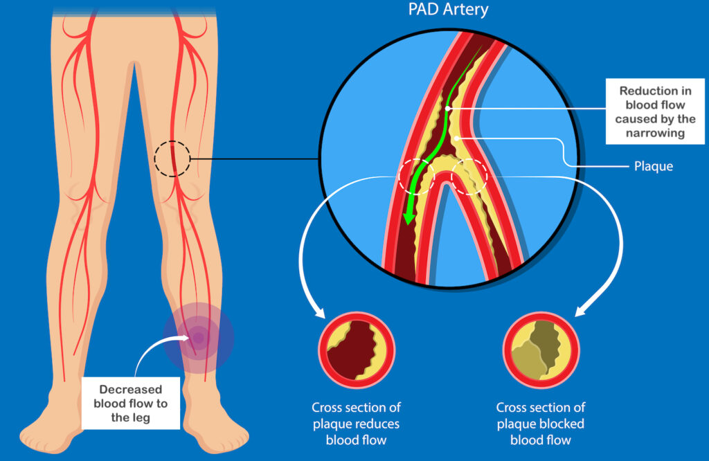 Peripheral Vascular Disease Vista Vascular Clinic