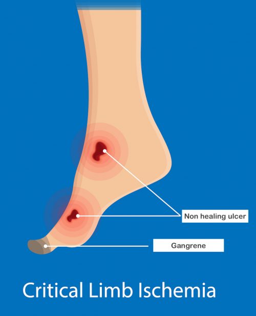 Critical limb ischemia