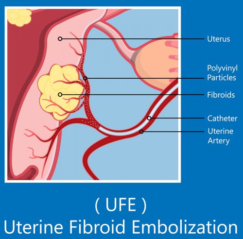 Magnified illustration - showing the UFE procedure