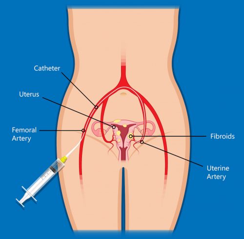 Catheter advanced into the Uterine artery by accessing the femoral artery